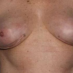 Nipple Areola Preservation (NAP) Before & After Patient #984