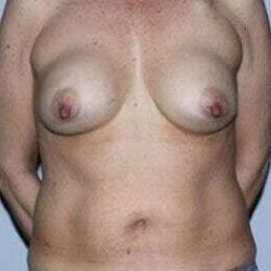 Nipple Areola Preservation (NAP) Before & After Patient #987