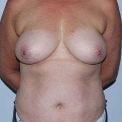Nipple Areola Preservation (NAP) Before & After Patient #990