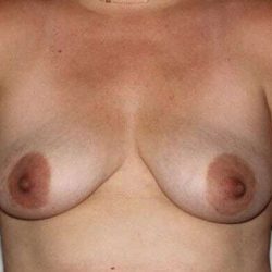 Nipple Areola Preservation (NAP) Before & After Patient #993