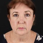 All Me Facelift Before & After Patient #366