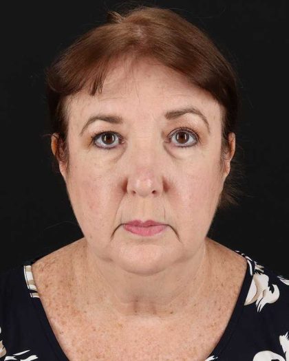 All Me Facelift Before & After Patient #366