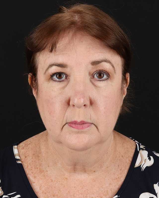 All Me Facelift Before & After Patient #366