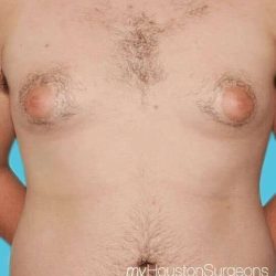 Gynecomastia Before & After Patient #1075