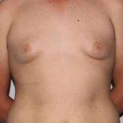 Gynecomastia Before & After Patient #1080