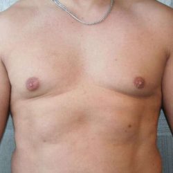 Gynecomastia Before & After Patient #1085