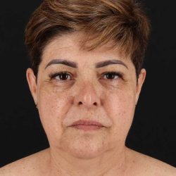 All Me Facelift Before & After Patient #373