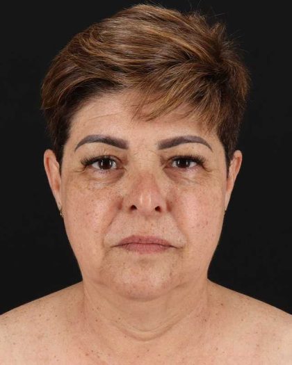 All Me Facelift Before & After Patient #373