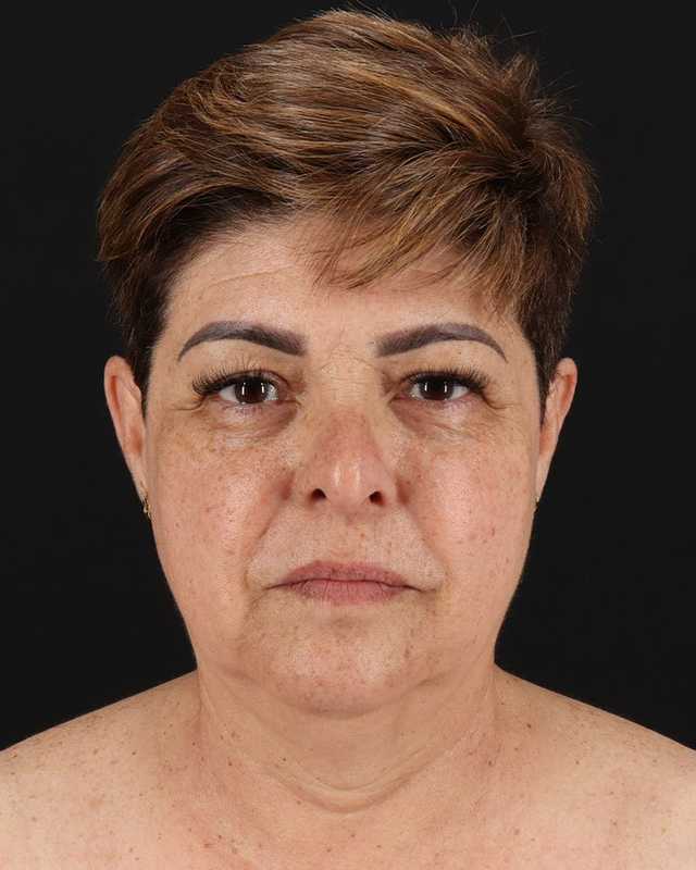 All Me Facelift Before & After Patient #373