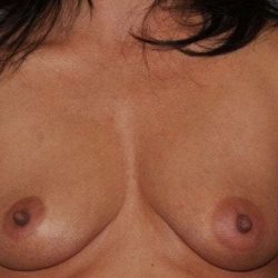 DIEP Flap Before & After Patient #1124
