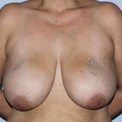 DIEP Flap Before & After Patient #1127