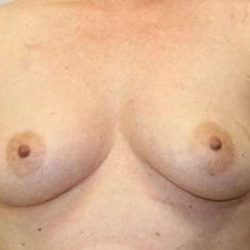 DIEP Flap Before & After Patient #1133
