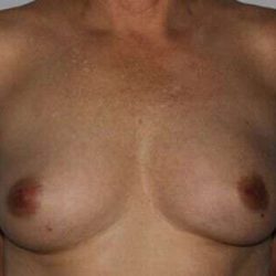 DIEP Flap Before & After Patient #1136