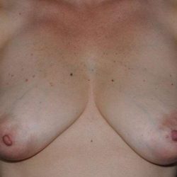 DIEP Flap Before & After Patient #1139