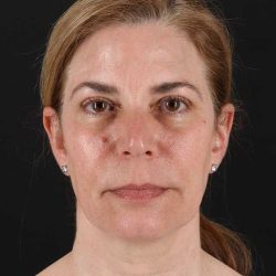 Lower Blepharoplasty Before & After Patient #384