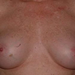 DIEP Flap Before & After Patient #1148