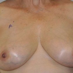 DIEP Flap Before & After Patient #1160