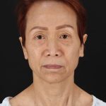 All Me Facelift Before & After Patient #395