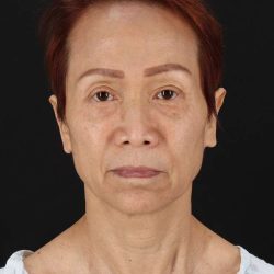 All Me Facelift Before & After Patient #395