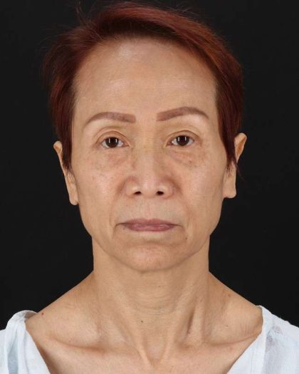 All Me Facelift Before & After Patient #395