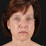 All Me Facelift Before & After Patient #229