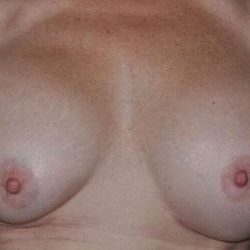 Breast Implant Revision Before & After Patient #1216