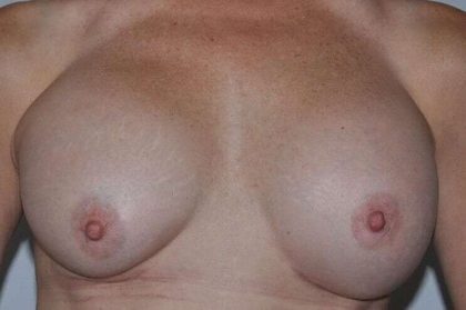 Breast Implant Revision Before & After Patient #1216