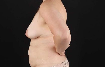 Breast Augmentation Before & After Patient #1230