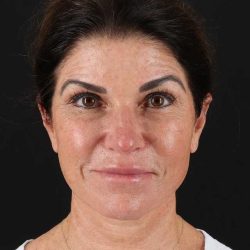 All Me Facelift Before & After Patient #406