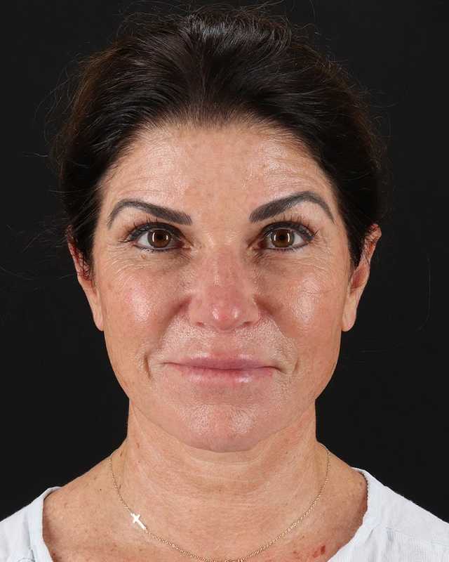 All Me Facelift Before & After Patient #406