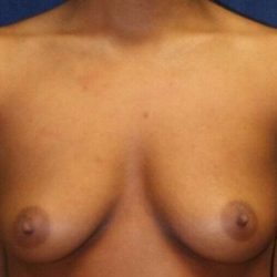 Breast Augmentation Before & After Patient #1271