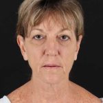 All Me Facelift Before & After Patient #418