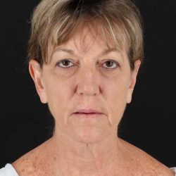 All Me Facelift Before & After Patient #418