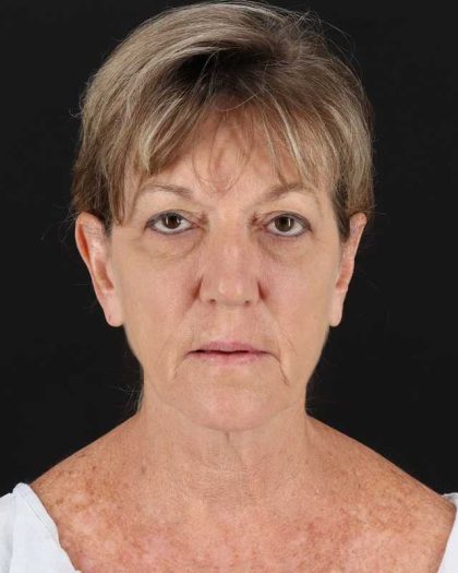 All Me Facelift Before & After Patient #418
