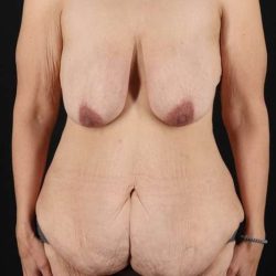 Breast Augmentation Before & After Patient #1346