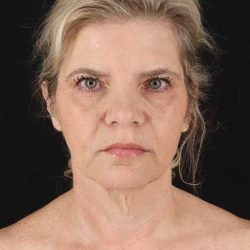All Me Facelift Before & After Patient #428