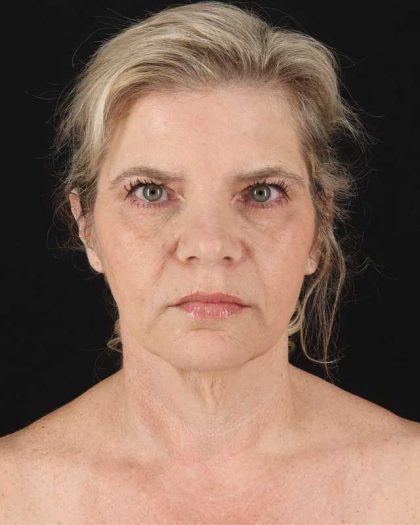 All Me Facelift Before & After Patient #428