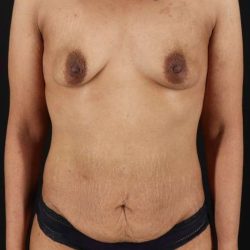 Breast Augmentation Before & After Patient #1367