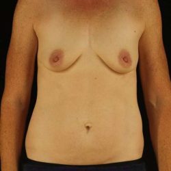 Breast Augmentation Before & After Patient #1374