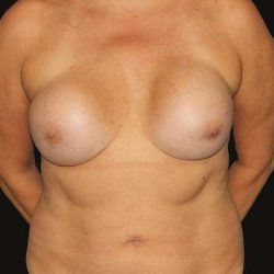 Breast Augmentation Before & After Patient #1391