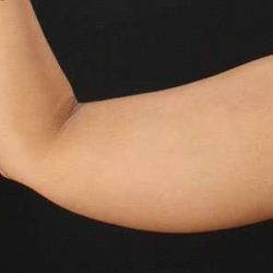 Liposuction Before & After Patient #1409