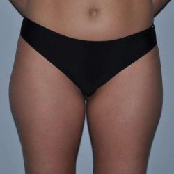 Liposuction Before & After Patient #1427
