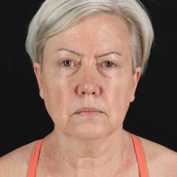 All Me Facelift Before & After Patient #439