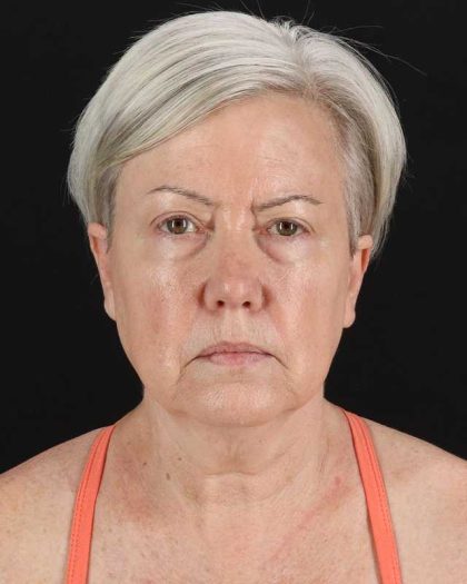 All Me Facelift Before & After Patient #439