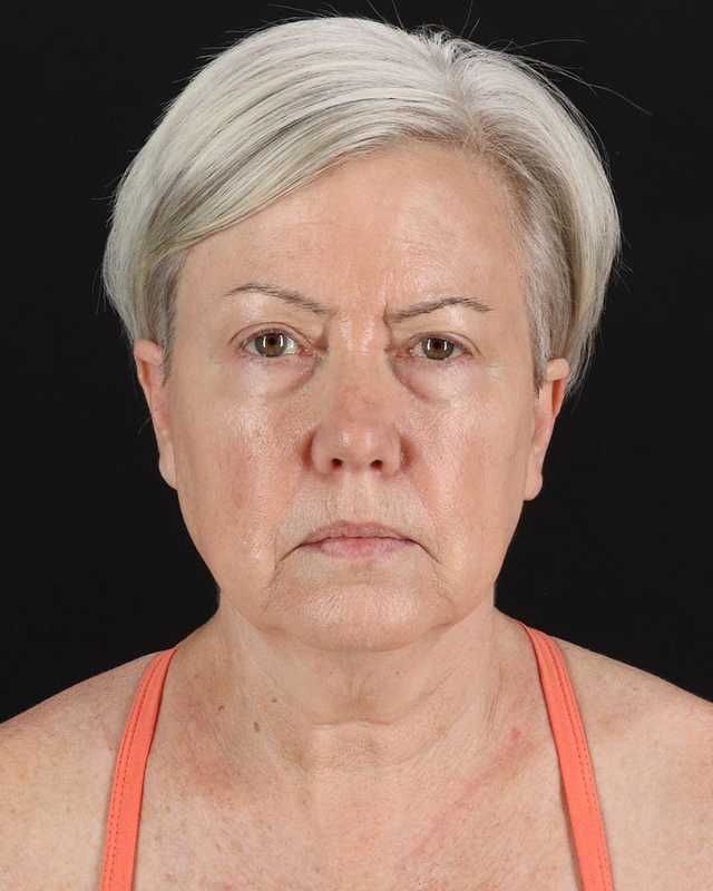 All Me Facelift Before & After Patient #439