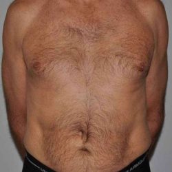 Liposuction Before & After Patient #1432