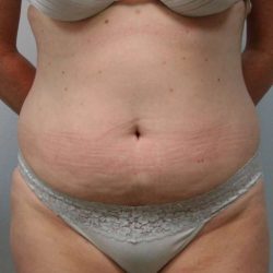 Liposuction Before & After Patient #1437