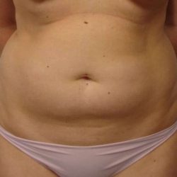 Liposuction Before & After Patient #1442