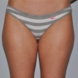 Liposuction Before & After Patient #1450