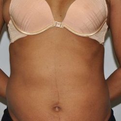 Liposuction Before & After Patient #1455